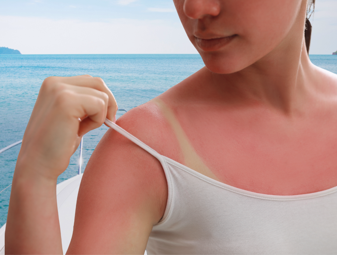 Sunburn